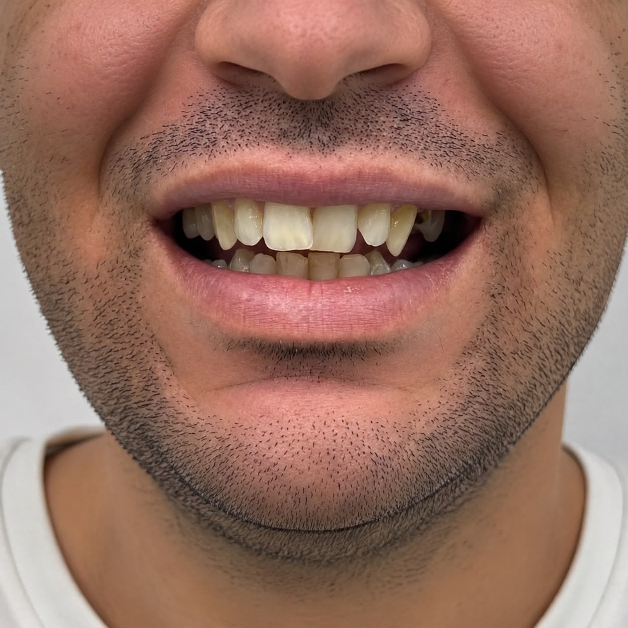 Sonrisa antes del tratamiento dental